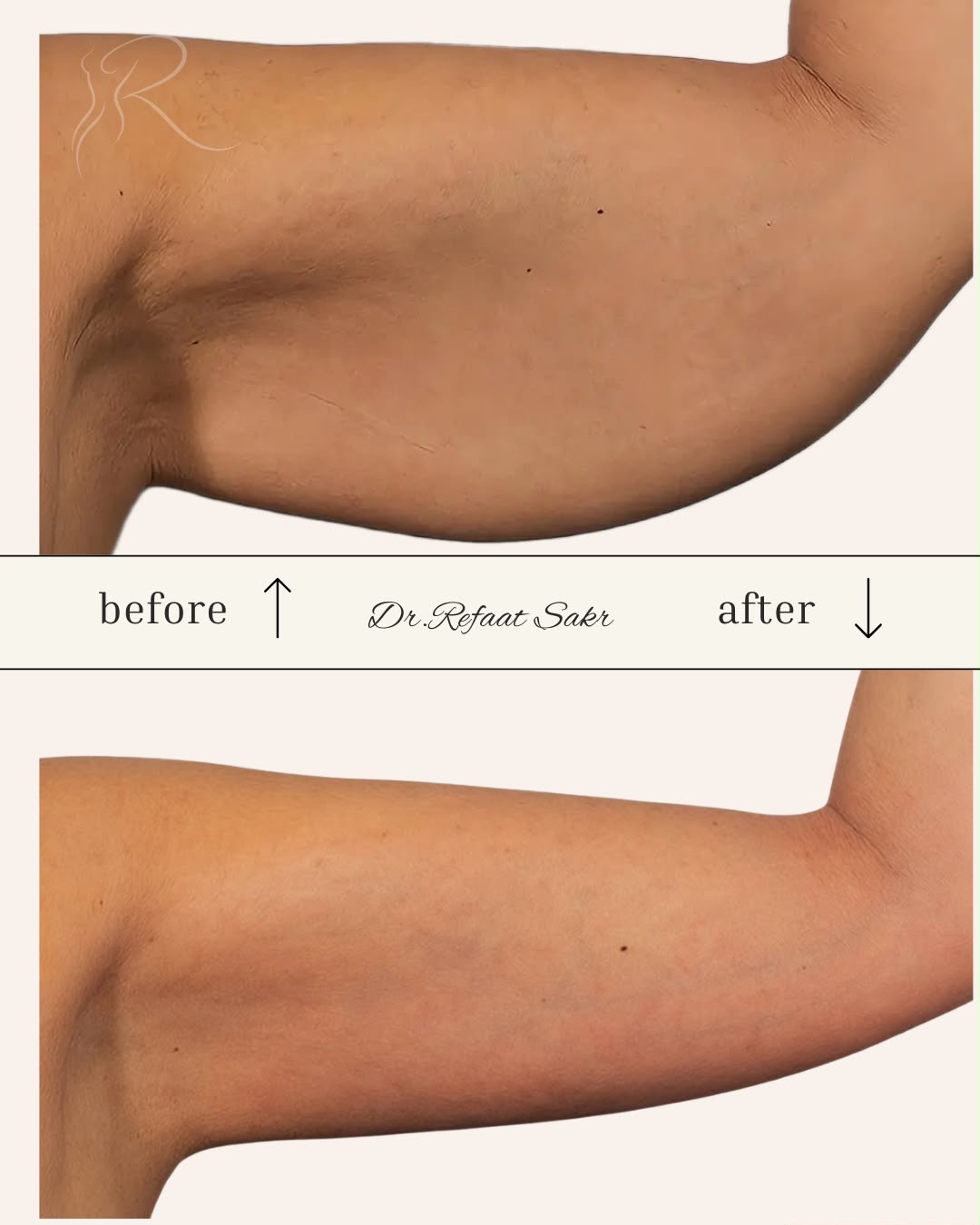 Result — Arm Contouring