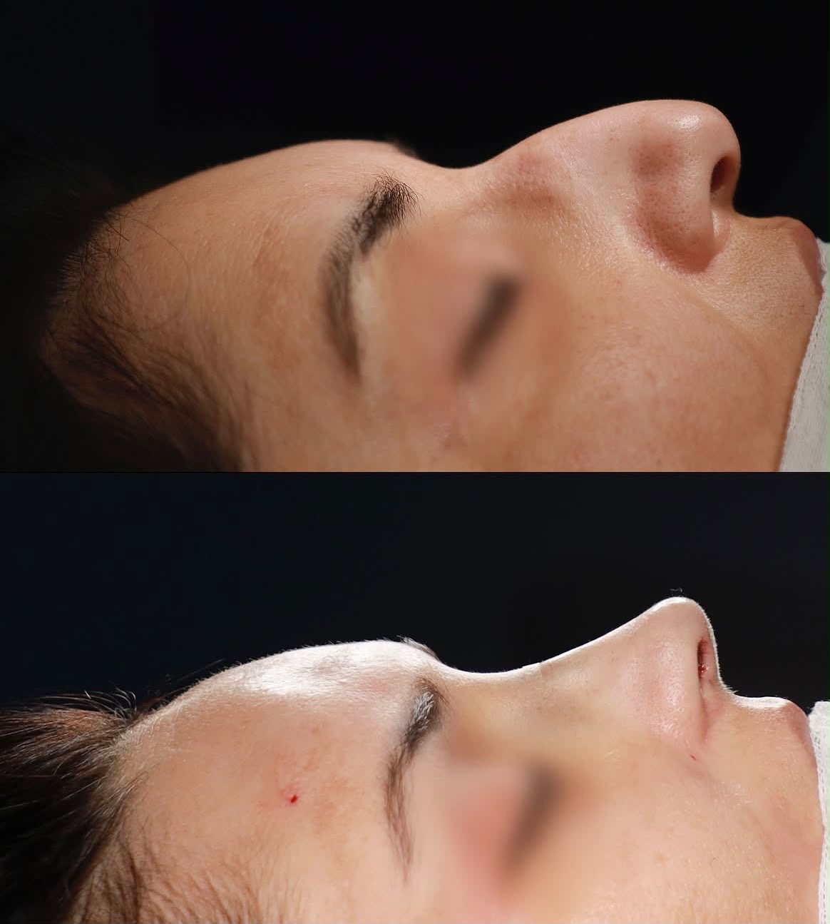 Result — Rhinoplasty