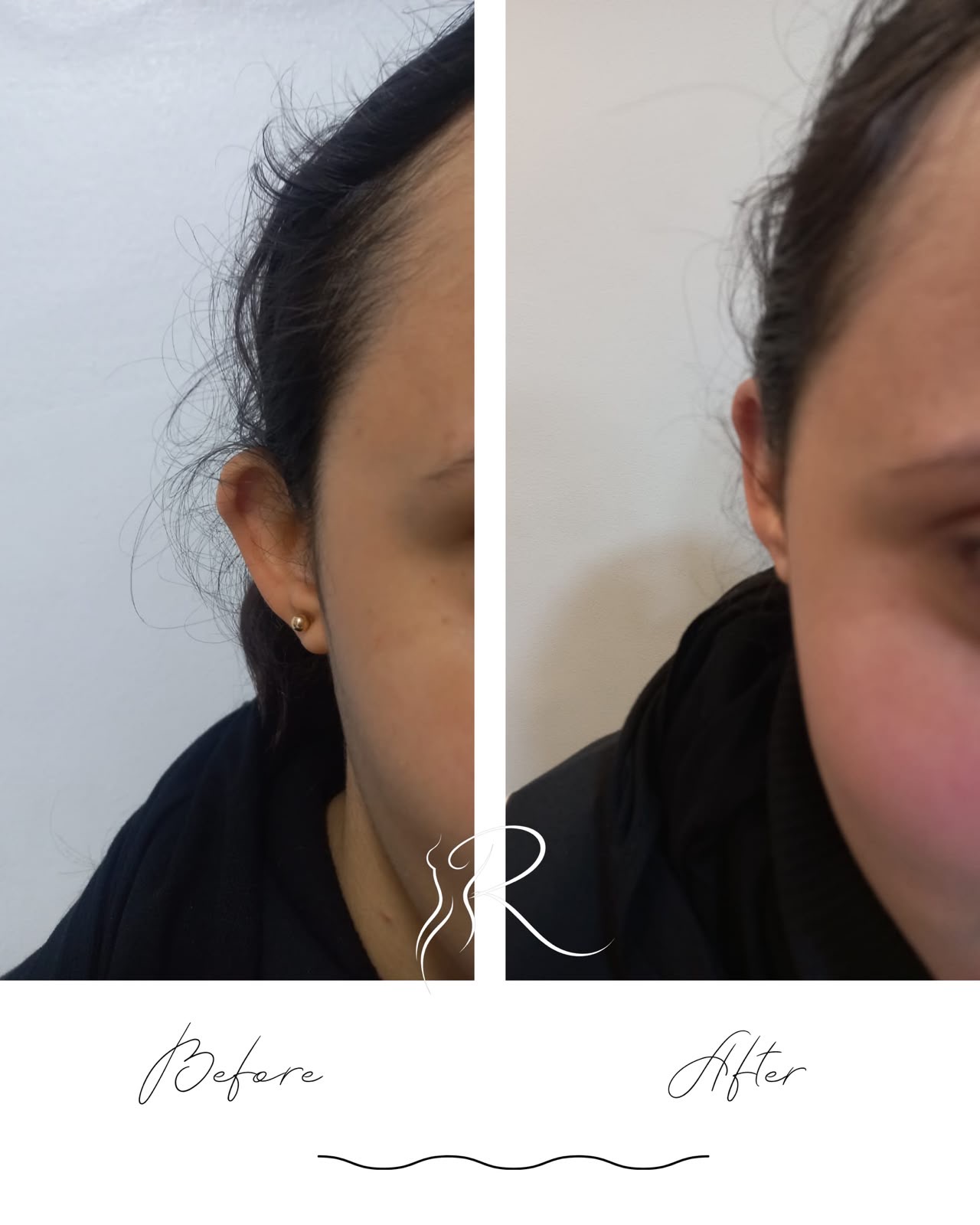 Result — Otoplasty